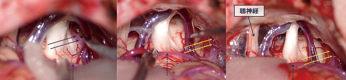 図4：三叉神経痛の術中画像（左は術前、中央は術後1、右は術後2）