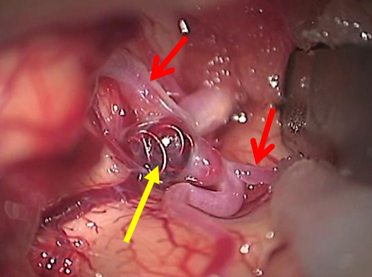 図5：coilの入った状態で開頭手術をした画像