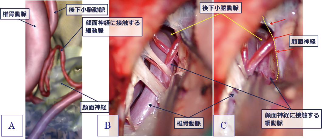 顔面けいれん Hemifacial Spasm 開頭術 流山中央病院 脳神経外科ホームページです 日本脳神経血管内治療学会研修施設 認定病院 脳動脈瘤 クモ膜下出血 脳出血 脳梗塞などの血管障害だけでなく 脳動静脈奇形や硬膜動静脈瘻といった 珍しい疾患もカバーし