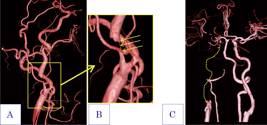図1：頚部内頚動脈高度狭窄（A, B）、と閉塞（C）の画像