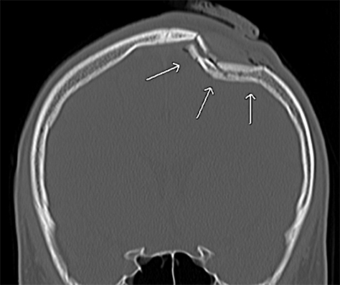 頭部外傷 流山中央病院 脳神経外科ページ