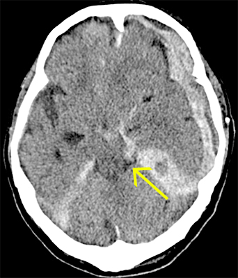 頭部外傷 流山中央病院 脳神経外科ページ