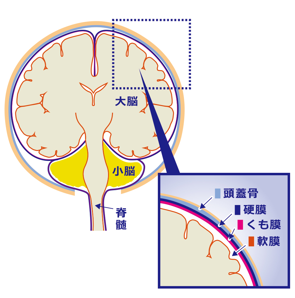 くも膜 下 出血 家族 に できること