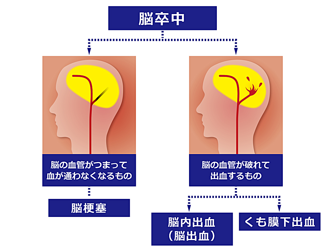 脳卒中 脳梗塞 脳出血 くも膜下出血 流山中央病院 脳神経外科ページ