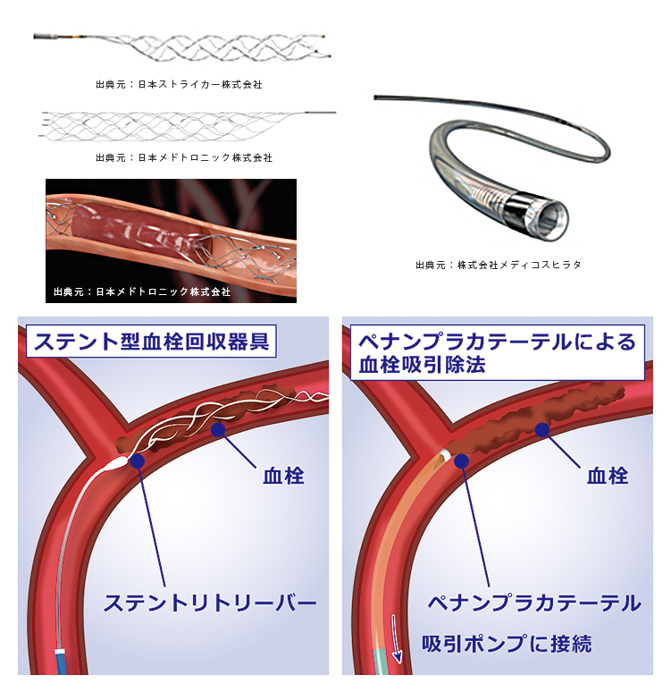 心筋 梗塞 カテーテル 手術